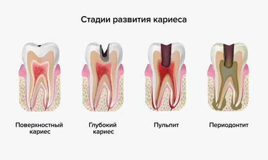 Что такое кариес
